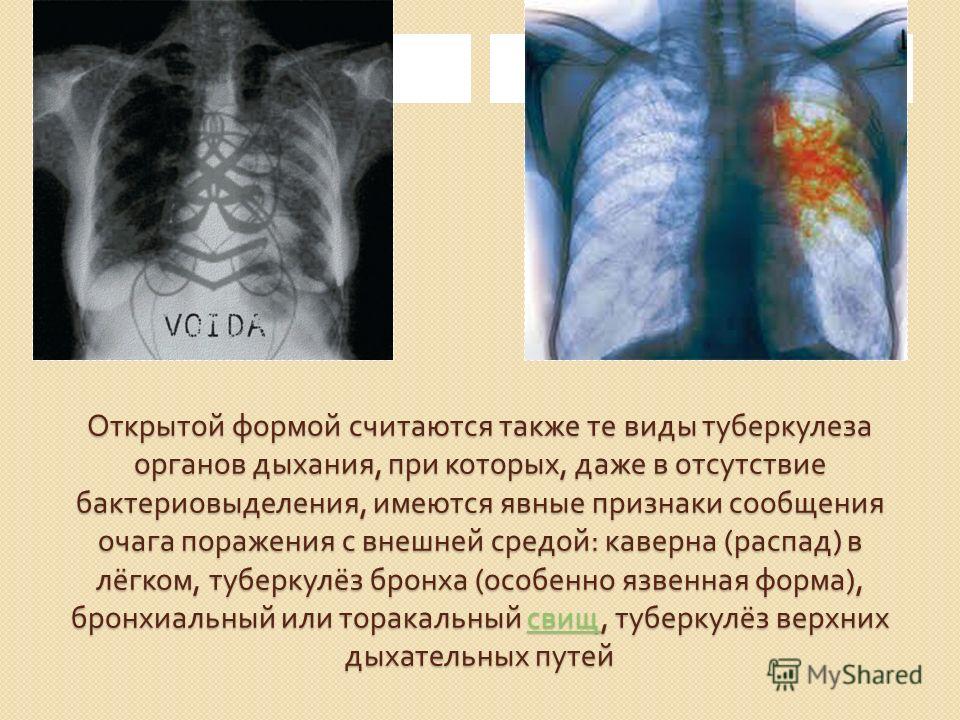 Открытый туберкулез