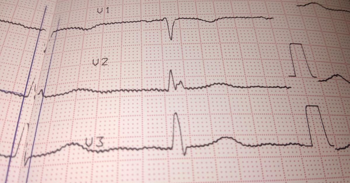 Синдром бругада на экг фото