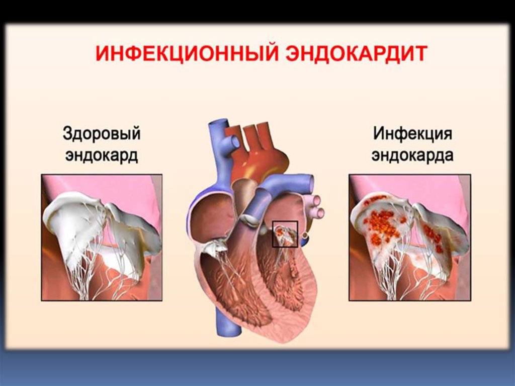 Бак эндокардит митрального клапана