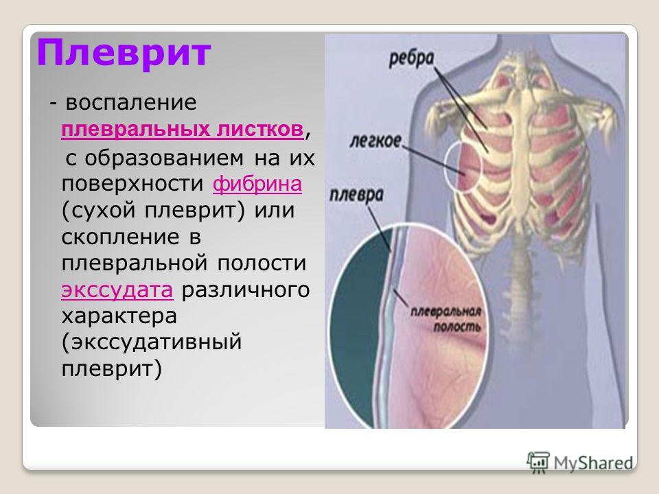 Плеврит легких картинки