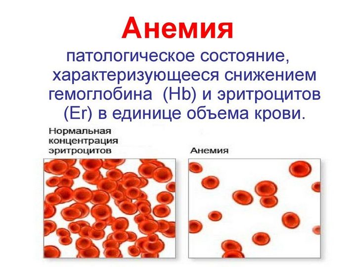 Анемия в крови
