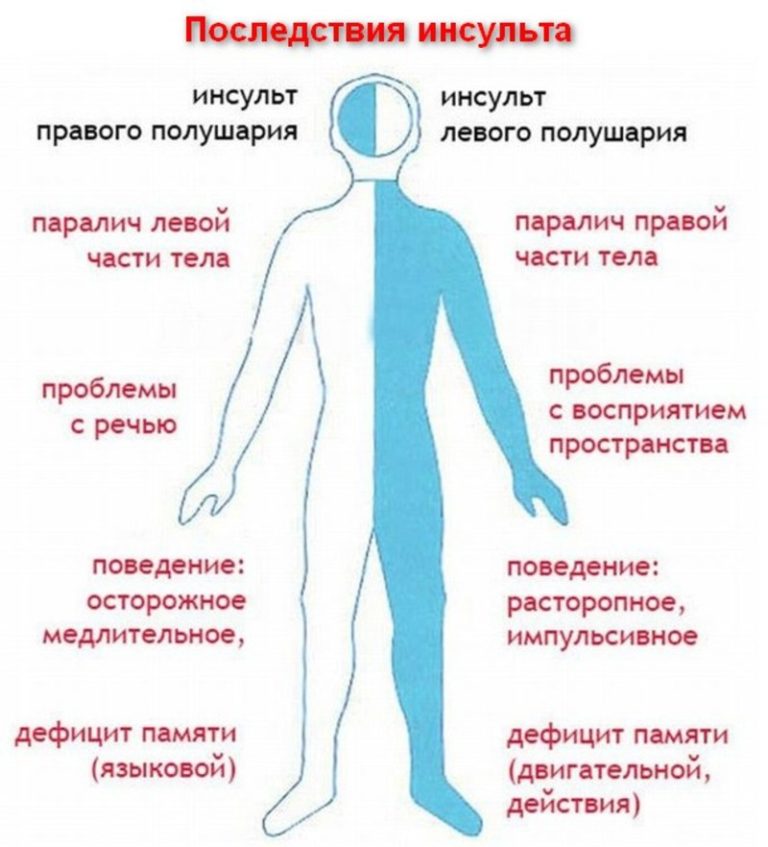 Начните двигаться руководство по восстановлению двигательных функций после перенесенного инсульта