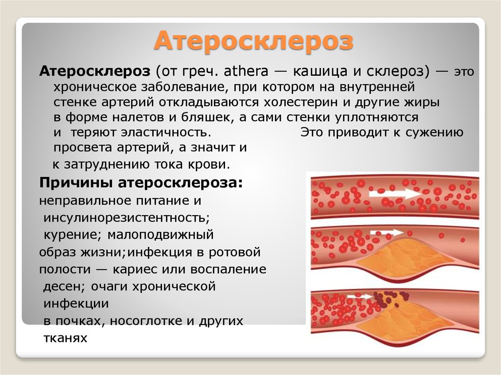 Болезни сосудов крови. Атеросклероз бляшки сосудов. Атеросклеротическое поражение артерий.