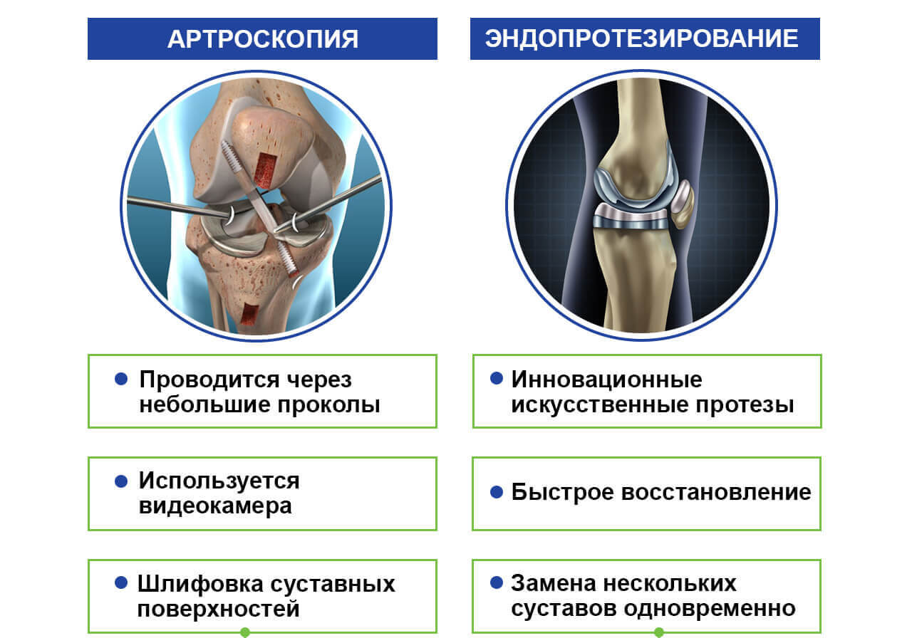 Клиническая картина артроза