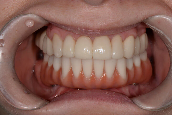 Зубные импланты